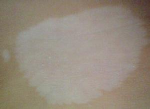 白癜风如何治疗需要的时间短 白癜风如何治疗需要的时间短