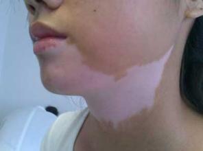 夏季女性白癜风患者怎么护理 夏季女性白癜风患者怎么护理